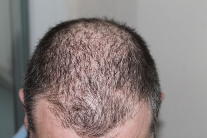 hair fall बालों के झड़ने के प्रमुख कारण