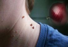 Remove wart with the help of onion