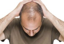 इन फूड्स का सेवन करने से बढ़ता है गंजापन, जाने कैसे baldness