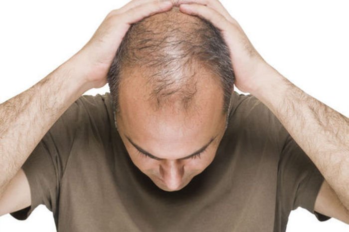 baldness