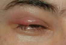 बारिश के मौसम में आंखों के संक्रमण से कैंसे बचें Eye Infection