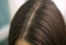dandruff